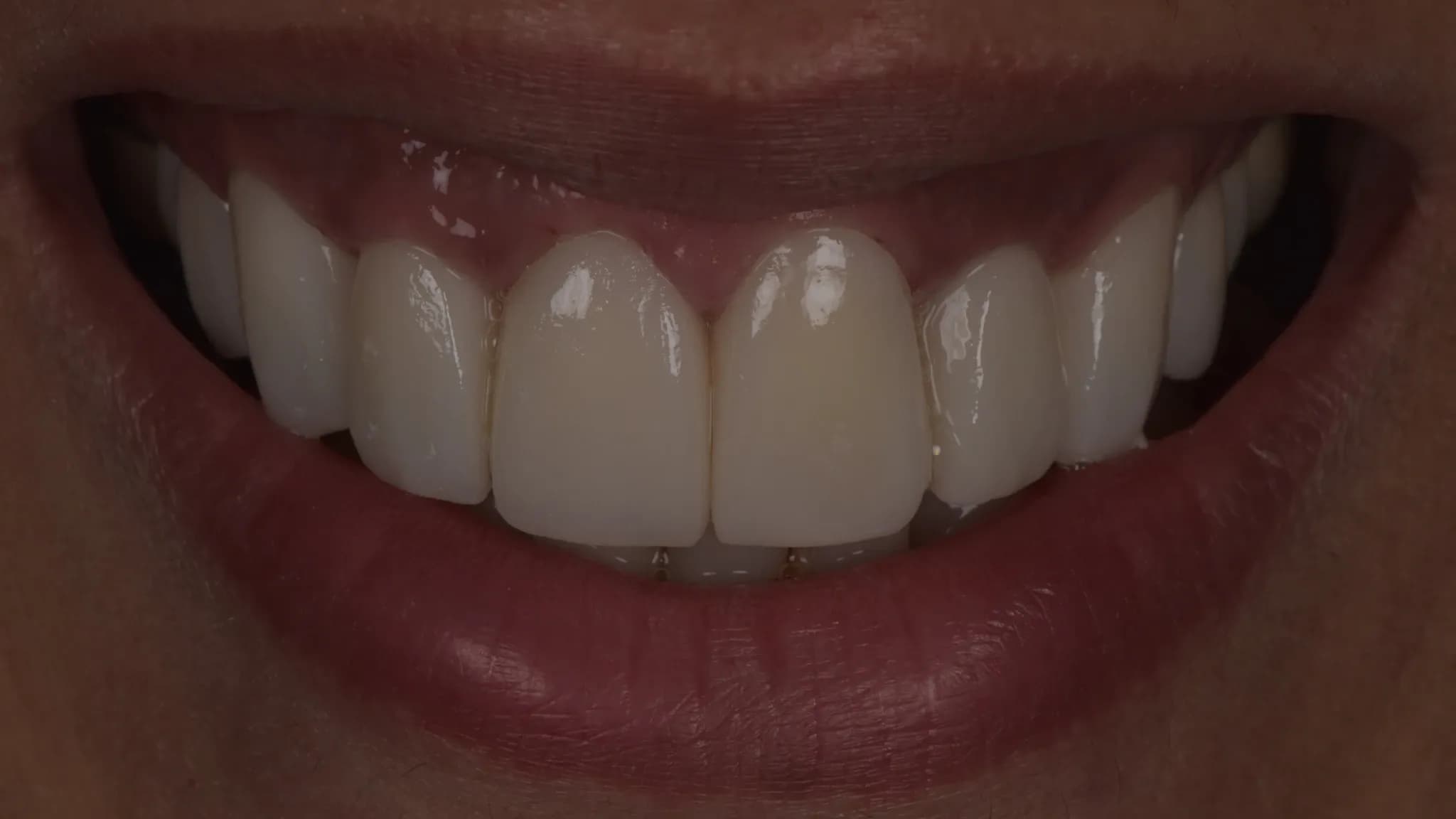 spectrum gallery 02 porcelain veneers later