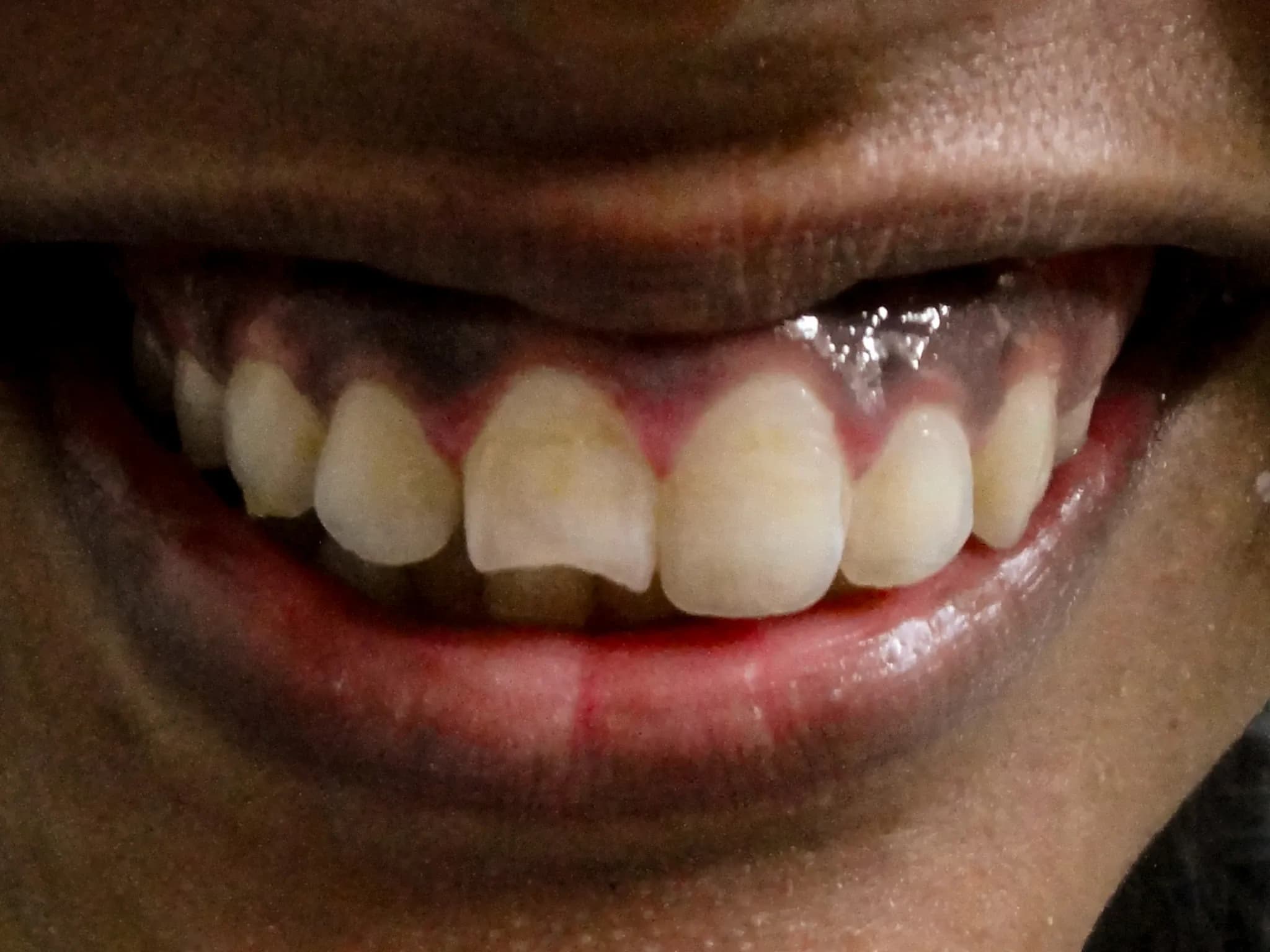 spectrum gallery 03 orthodontics and veneers earlier