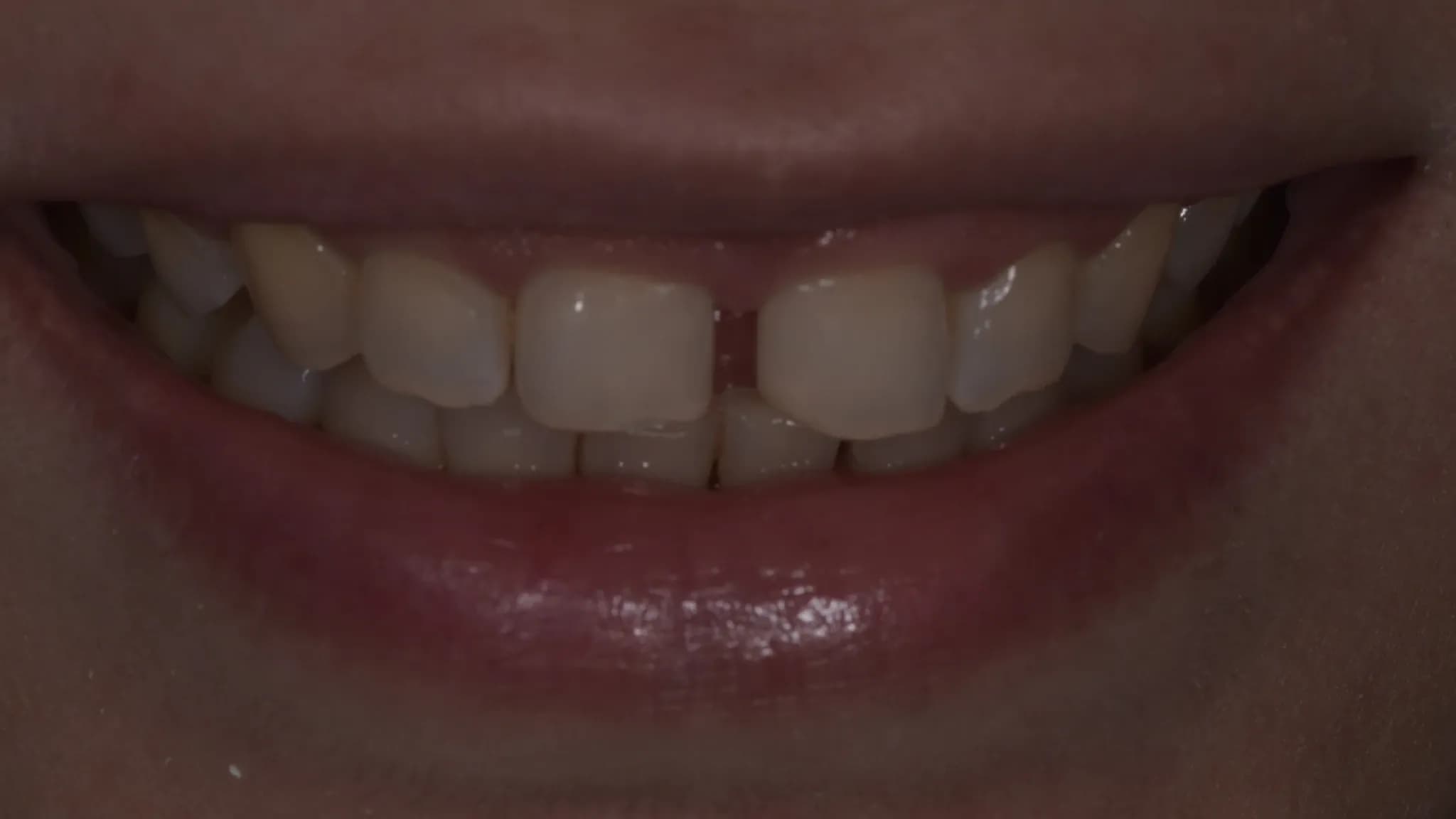 spectrum gallery 05 ultrathin veneers earlier