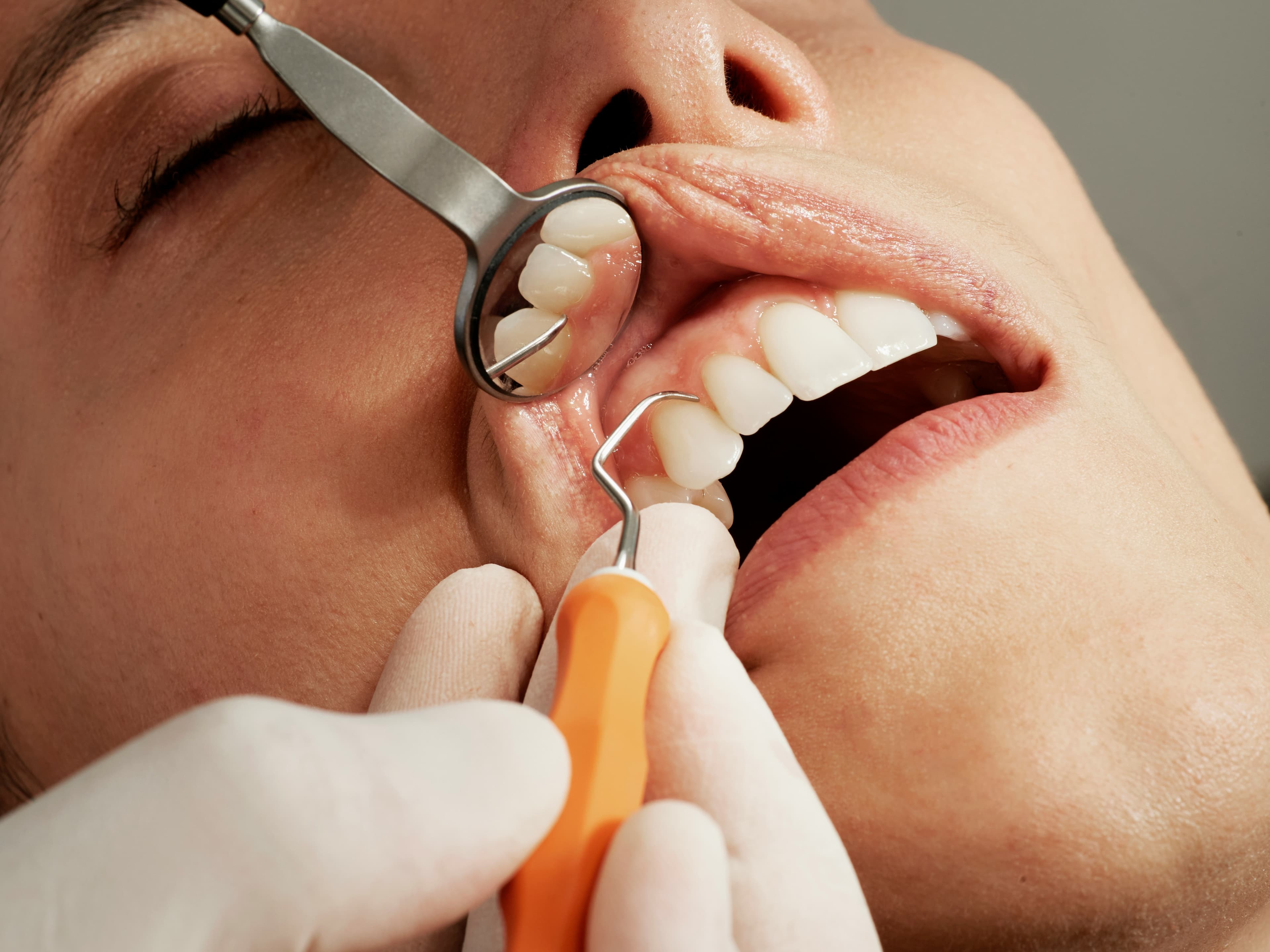 dental-filling-image