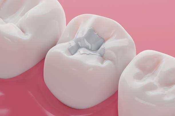 tooth-filling